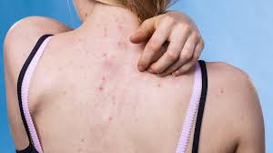 Hình ảnh viêm nang lông lưng trước điều trị